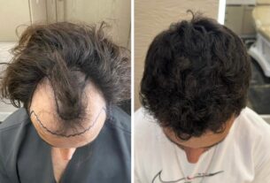 Inovações ajudam a popularizar busca por transplante capilar