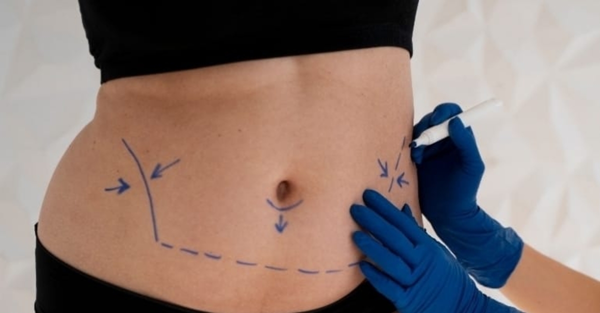 Mini ou abdominoplastia: especialista aponta melhor escolha