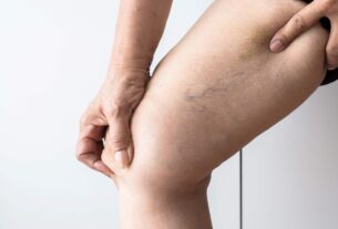 Tratamento de varizes evolui com métodos menos invasivos