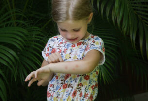 Picada de mosquito pode ser aliviada com cuidados especiais