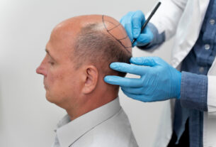 Turquia lidera procura internacional por transplante capilar