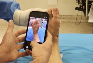 Tratamento das joanetes avança com cirurgia pouco invasiva