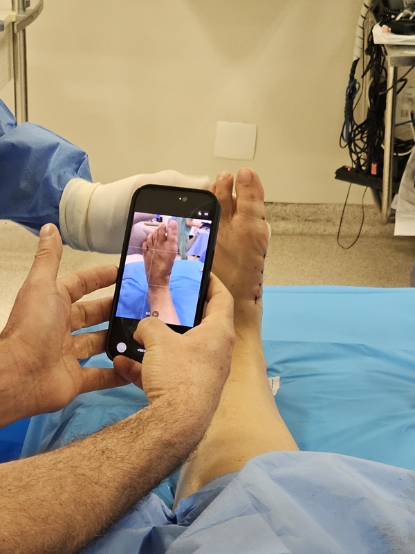 Tratamento das joanetes avança com cirurgia pouco invasiva