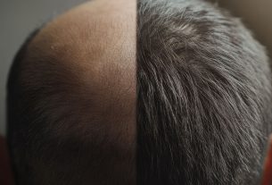 Demanda por transplante capilar valoriza resultados naturais
