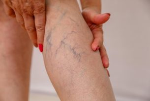 Obesidade e varizes têm relação e exigem atenção médica