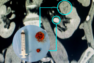 Nefrectomia robótica preserva rins com alta precisão